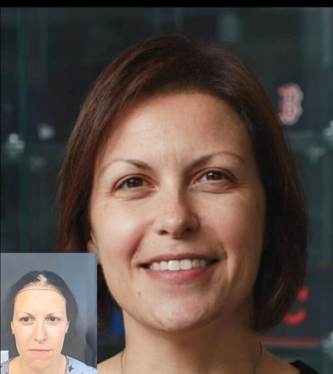 Hair Restoration for Women